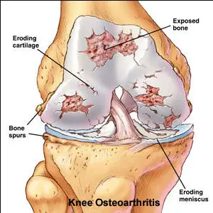 Treatments for Osteoarthritis of Knee