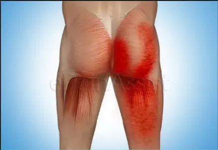 sore buttock muscles causes