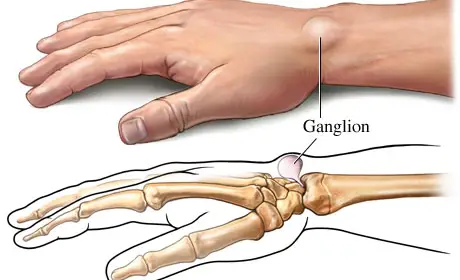 Sudden Wrist Pain For No Reason- Ganglion Cyst In Wrist