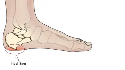 What Does a Heel Spur Look Like?