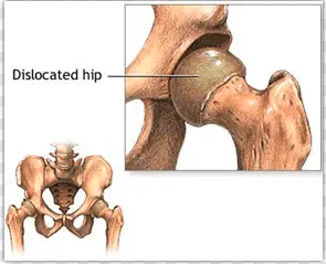 Signs and symptoms of dislocated hip