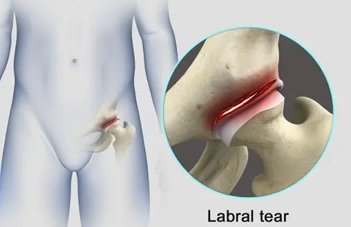 What Does a Hip Labral Tear Feel Like