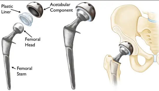 how long does hip replacement recovery take