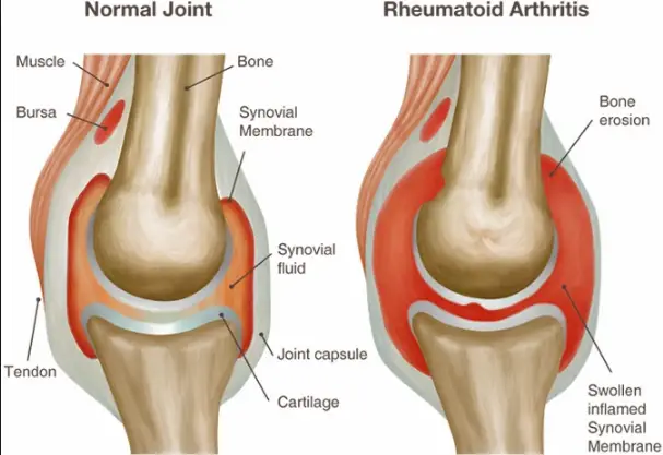 How to Cure Rheumatoid Arthritis Permanently
