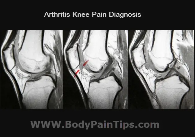 Arthritis knee pain diagnosis