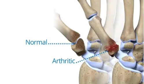 Causes of Osteoarthritis In The Knee