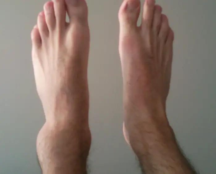 How To Tell if Ankle is Broken or Sprained