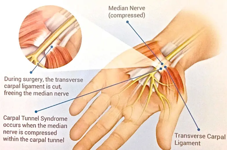 Surgery for Carpal Tunnel Syndrome