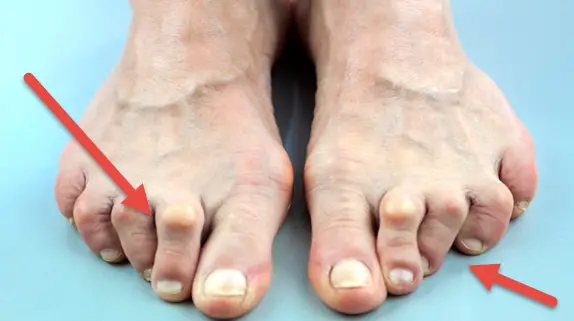 rigid deformity of the toe