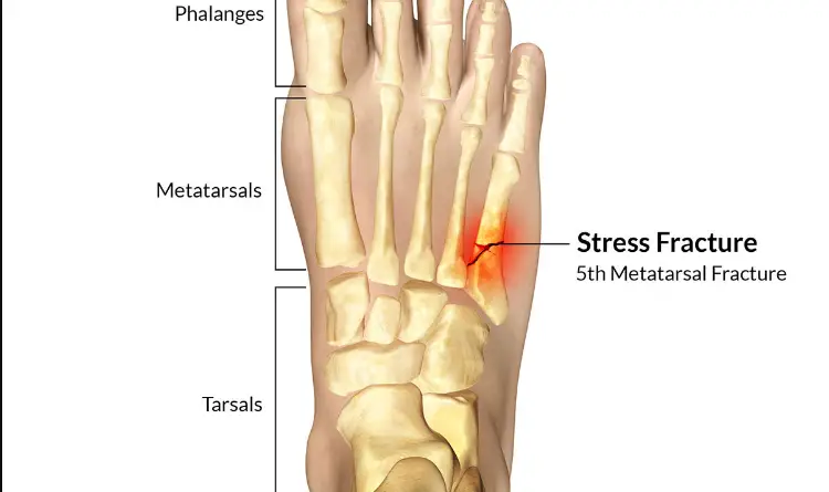 What Does a Stress Fracture in The Foot Feel Like