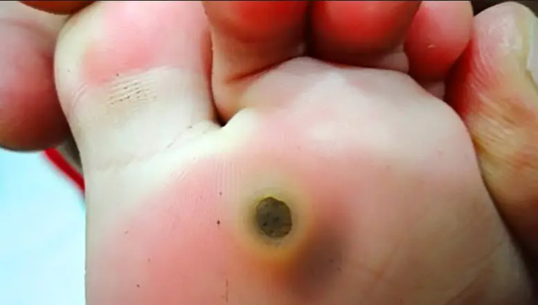 What Does a Plantar Wart Look Like