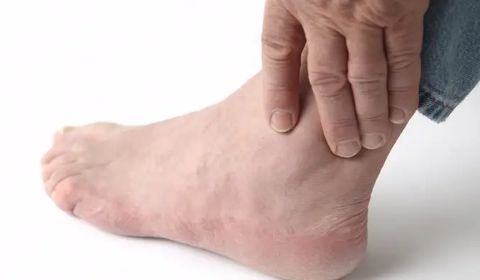 Causes of Ankle Pain and Swelling gouty arthritis