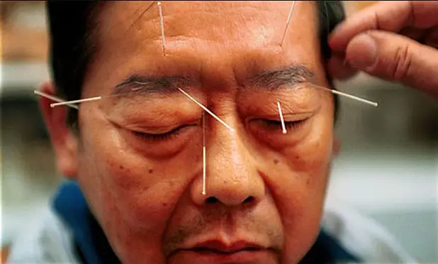 Does Acupuncture Help Migraines