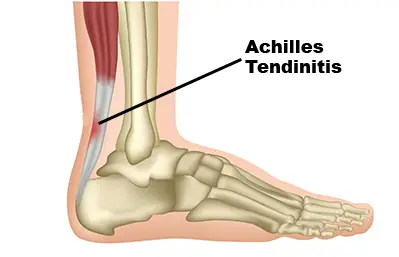What Causes Pain in The Back of Your Heel, Achilles tendinitis