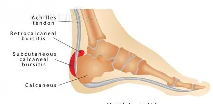 What Causes Pain in The Back of Your Heel, Retrocalcaneal bursitis