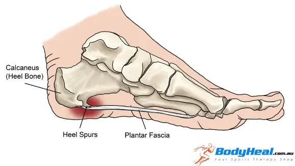 What Causes Pain in The Back of Your Heel, heel spurs