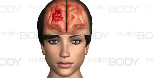 brain tumor headache characteristics
