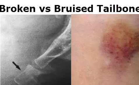 bruised tailbone vs broken tailbone