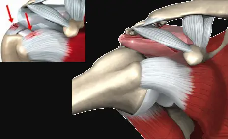 tendonitis in shoulder