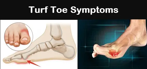 Turf Toe Symptoms