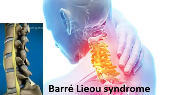 Barré Lieou syndrome