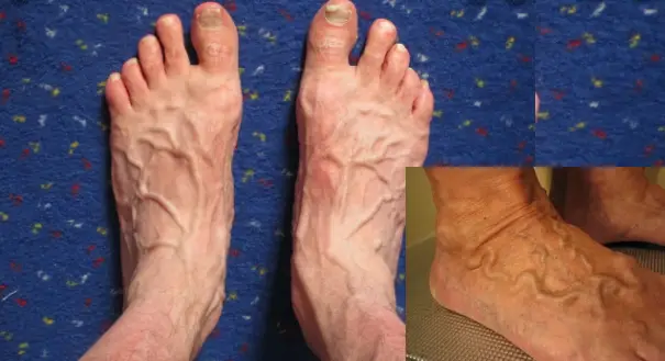 blue-bulging-veins-on-foot-discount-emergencydentistry