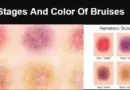Stages And Color Of Bruises