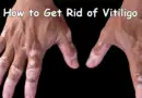 How to Get Rid of Vitiligo – 6 Home Remedies